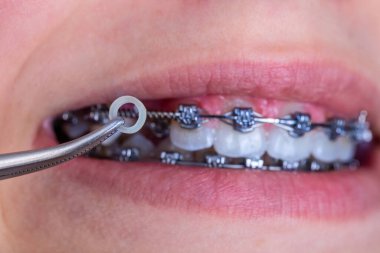 Hasta ayraçları düzeltmesi için elastik lastik bant ile ortodontist aracını kapat.