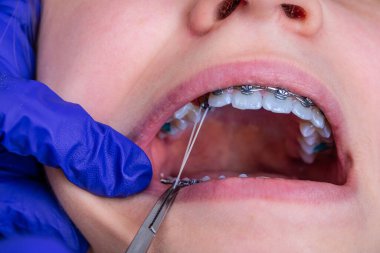 Ortodontist elleri kapatın ve hasta parantezlerine elastik lastik bantlar takın..