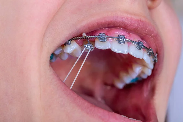 Girl with braces and elastic rubber. Orthodontist treatment.
