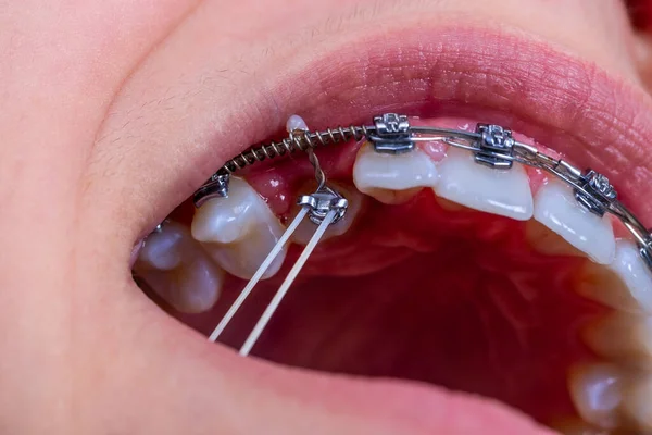 Girl with braces and elastic rubber. Orthodontist treatment.