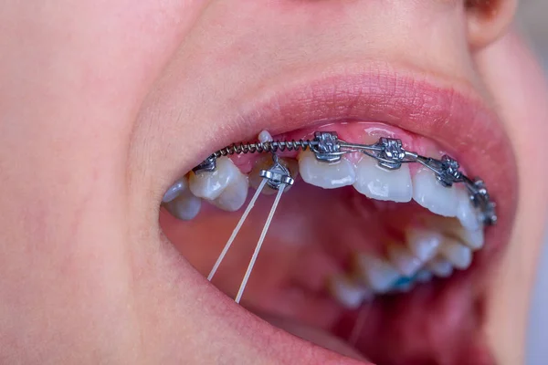 Girl with braces and elastic rubber. Orthodontist treatment.