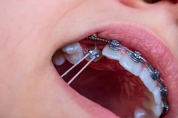 Girl with braces and elastic rubber. Orthodontist treatment.