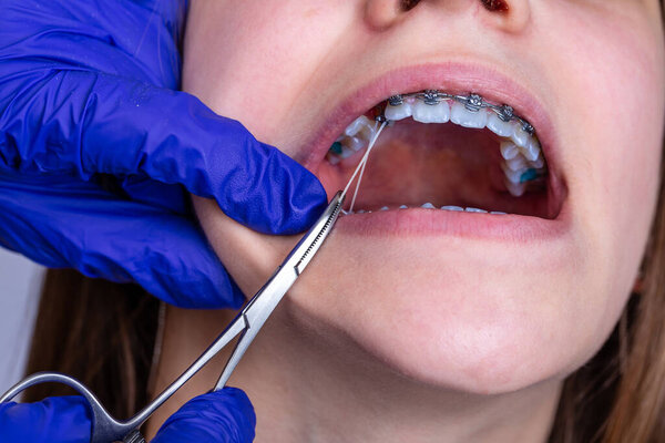 Close up of orthodontist hands putting elastic rubber band on patient brackets.