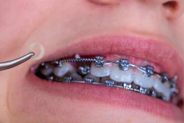 Close up of orthodontist tool with elastic rubber band for patient brackets correction.