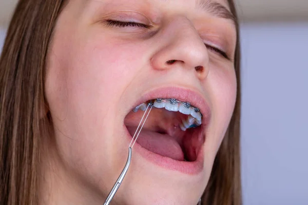 Tweens are making braces out of paper clips, rubber bands — and  predictably, it's damaging their teeth