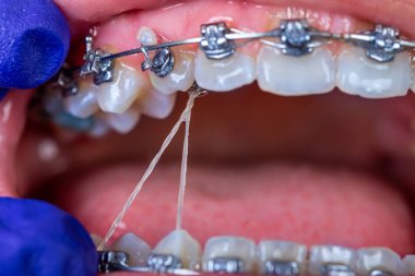 Diş teli sistemini kapat.