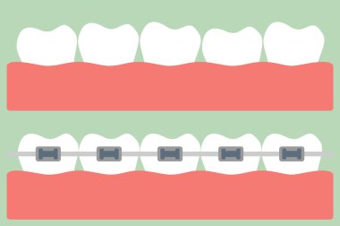 çizgi film dişler Ortodonti