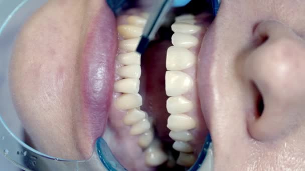 Blanchiment Des Dents Clinique — Video
