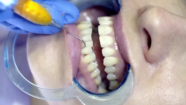 Отбеливание Зубов Клинике — стоковое видео