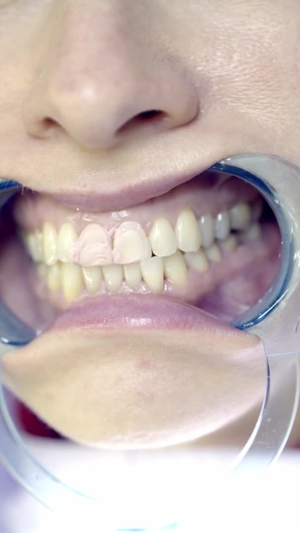 Λεύκανση Δοντιών Στην Κλινική — Αρχείο Βίντεο