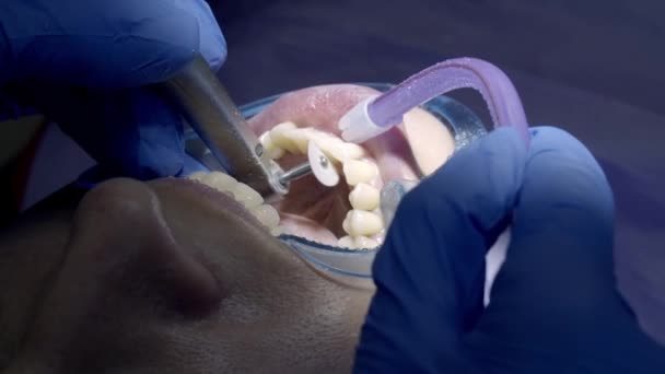Полировка Зубов Стоматолога — стоковое видео