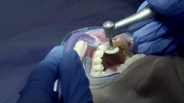 Dentes Polimento Dentista — Vídeo de Stock