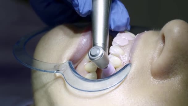 Відбілювання Зубів Стоматолога — стокове відео