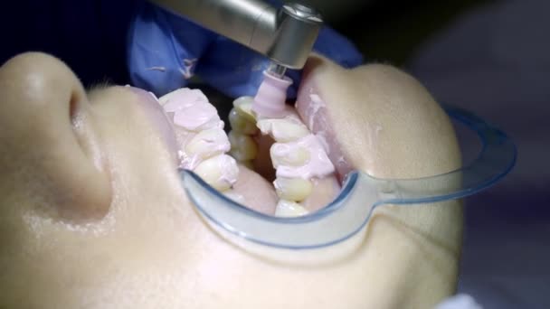 Bělení Zubů Zubaře — Stock video