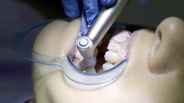 Bělení Zubů Zubaře — Stock video