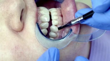 Klinikte diş kaplaması kurulumu