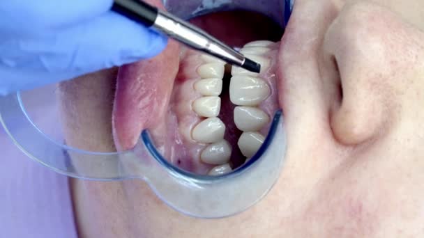 Instalare Fatete Dentare Clinica — Videoclip de stoc