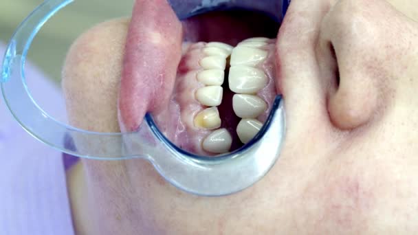 Εγκατάσταση Οδοντιάτρων Στην Κλινική — Αρχείο Βίντεο