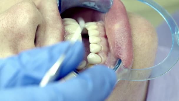 Instalación Carillas Dentales Clínica — Vídeo de stock