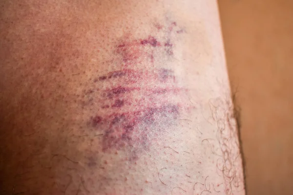 huge bruise on the body. Close-up - wounded leg with bruise and abrasion. Injured skin. Household injuries, harm to health, domestic violence. Bruise on man\'s body as result of an accident.