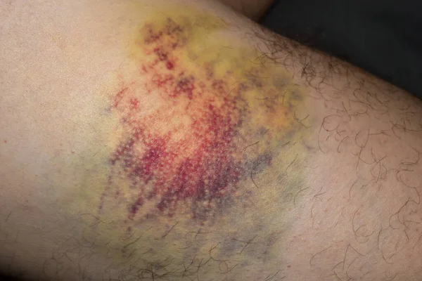 Huge Multi Colored Bruise Body Close Wounded Leg Bruise Abrasion — Stock Photo, Image