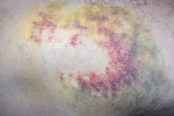 multi-colored bruise on body. Close-up is wounded leg with bruise and abrasion. Injured skin. Household injuries, harm to health, domestic violence. Bruise on body as result of an accident. stage 3