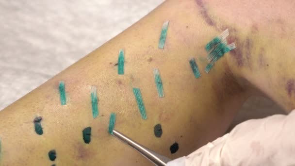 Remoção de sutura, placas com pernas 2 — Vídeo de Stock