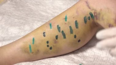 Dikiş kaldırma, bacaklar 3 ile plakalar