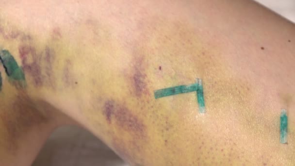 Extirpación de sutura, placas con las piernas debajo de la rodilla, primer plano 2 — Vídeos de Stock