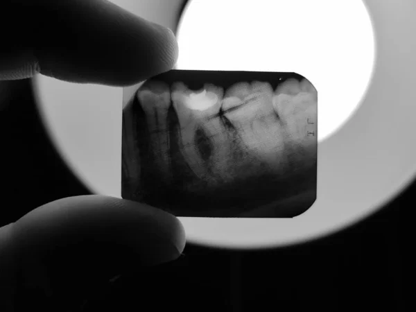 Resultado Radiografia Radiográfica Dos Dentes Cavidade Oral Paciente Ser Tratado — Fotografia de Stock