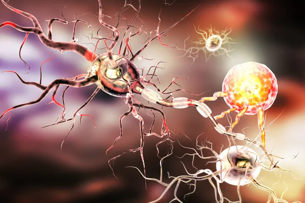 Nervceller, koncept för neurologiska sjukdomar, tumörer och hjärnkirurgi — Stockfoto