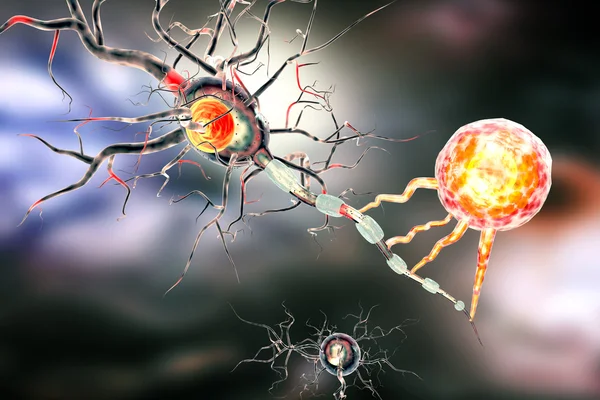 Cellule nervose, concetto di malattie neurologiche, tumori e chirurgia cerebrale Fotografia Stock