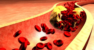 Clogged Artery with platelets and cholesterol plaque, concept for health risk for obesity or dieting and nutrition problems. 3D illustration clipart