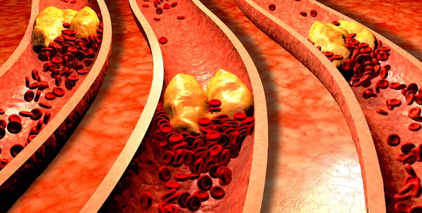 Arteria con plaquetas y placa de colesterol, concepto de riesgo para la salud por obesidad o problemas de dieta y nutrición. Ilustración 3D — Foto de Stock