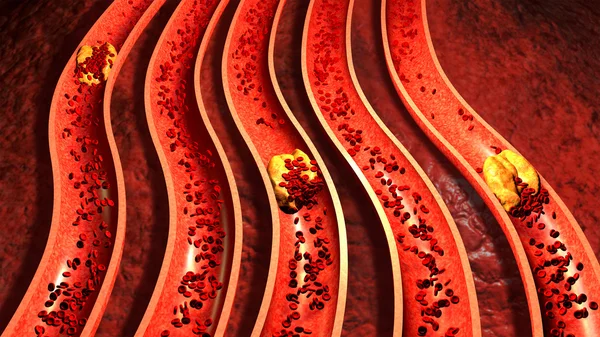 Arteria con plaquetas y placa de colesterol, concepto de riesgo para la salud por obesidad o problemas de dieta y nutrición. Ilustración 3D — Foto de Stock