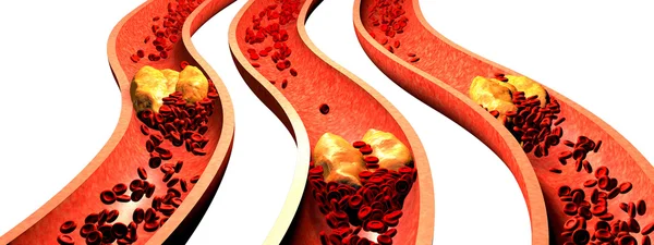 Arteria con plaquetas y placa de colesterol, concepto de riesgo para la salud por obesidad o problemas de dieta y nutrición. Ilustración 3D — Foto de Stock