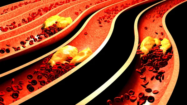 Засоренная артерия с тромбоцитами и бляшкой холестерина, концепция риска для здоровья от ожирения или диеты и проблем с питанием. 3D иллюстрация — стоковое фото