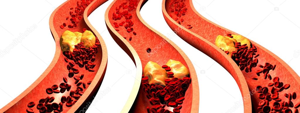 Clogged Artery with platelets and cholesterol plaque, concept for health risk for obesity or dieting and nutrition problems. 3D illustration