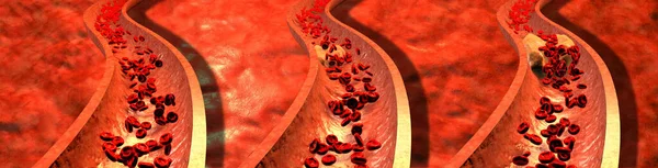 有血小板和胆固醇斑块的记录动脉 肥胖或节食的健康风险概念和营养问题 3D插图 — 图库照片