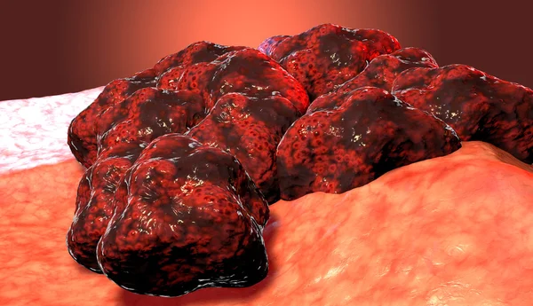 Tumeur des cellules cancéreuses, illustration médicale 3D — Photo