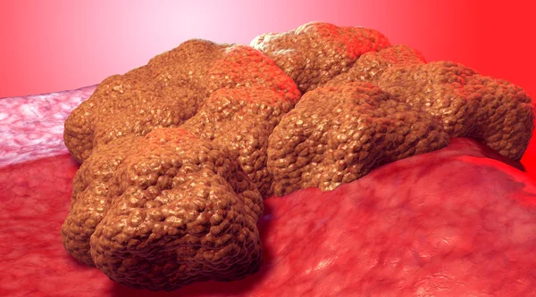 Cancer cell tumor, 3d medical illustration — Stock Photo, Image