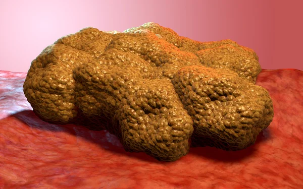 Tumor de células cancerosas, ilustración médica 3d — Foto de Stock