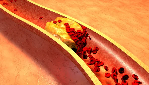 Verstopte slagader met bloedplaatjes en Cholesterol Plaque — Stockfoto