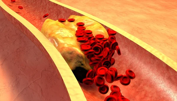 Verstopfte Arterie mit Blutplättchen und Cholesterin-Plaque — Stockfoto