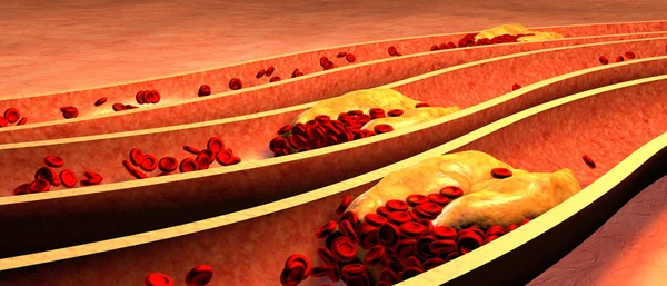 혈소판 과 콜레스테롤 플 래 크 로 엉겨 있는 동맥 — 스톡 사진