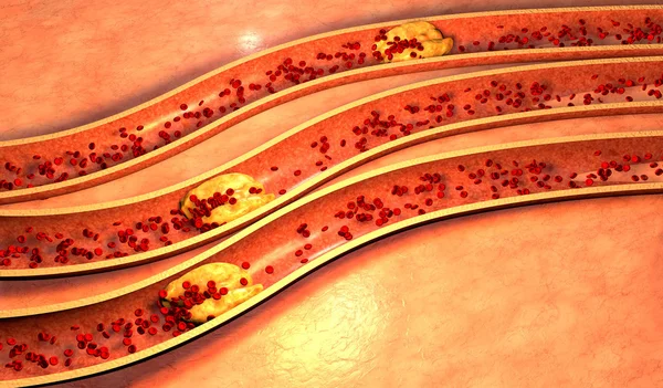 Verstopfte Arterie mit Blutplättchen und Cholesterin-Plaque — Stockfoto