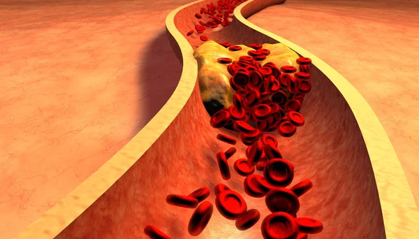 Verstopte slagader met bloedplaatjes en Cholesterol Plaque — Stockfoto