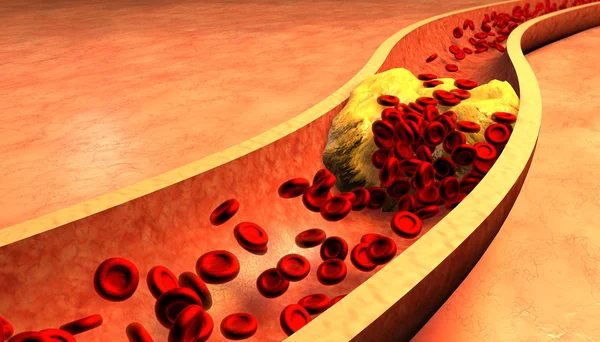 Verstopte slagader met bloedplaatjes en Cholesterol Plaque — Stockfoto