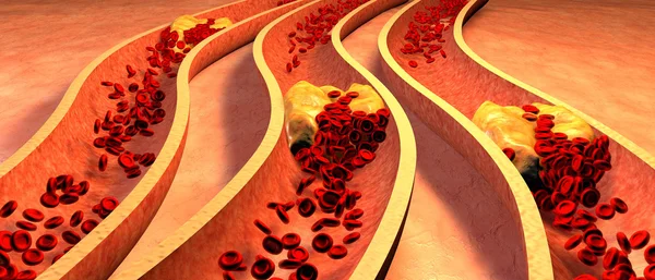 Arteria con piastrine e placca di colesterolo — Foto Stock