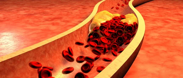 Artère bloquée avec plaquettes et plaque de cholestérol Images De Stock Libres De Droits